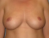 Patient # 27515 After Photo # 2